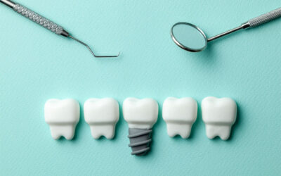 Perimplantite: cos’è, cure e prevenzione