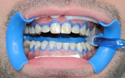 Lo sbiancamento dentale