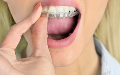 A cosa serve il bite dentale