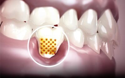 Gengive ritirate: curare i colletti dei denti scoperti