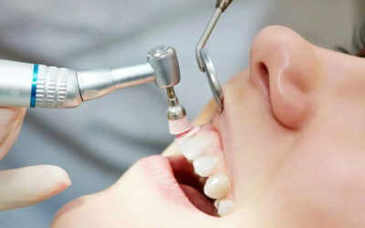 Igiene dentale: pulizia professionale dei denti a Cherasco