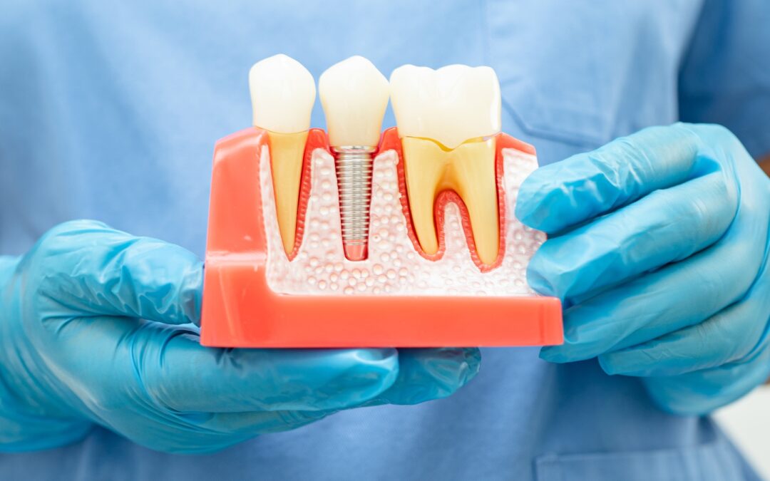 Chirurgia pre-implantare – il passo fondamentale prima dell’impianto