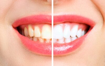 Sbiancamento dentale professionale a Cherasco